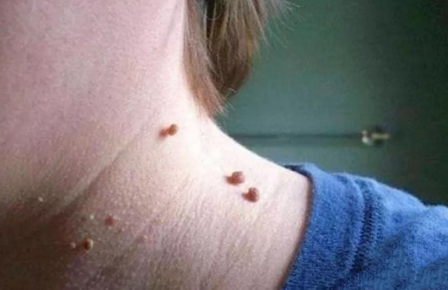 水猴子图片皮肤病,皮肤长小肉疙瘩是咋回事?