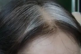 女性白头发日渐增多，先别以为自己老了，可能是缺乏3种营养图片