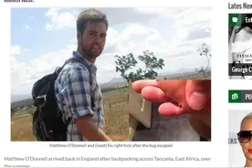 英男在非洲被沙蚤寄生 1个月后百颗虫卵从脚底爆出图片