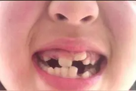 孩子乳牙整齐漂亮，换牙后却越长越丑？这些“毁牙”习惯孩子有吗图片