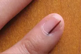 手指也能长痣？有“痣”青年注意了，可能是癌变信号图片