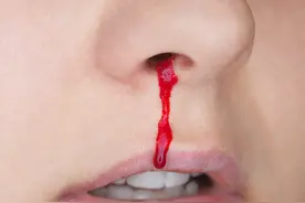 再次提醒：流鼻血时要冷静，2个方法能快速止血！不是仰头图片