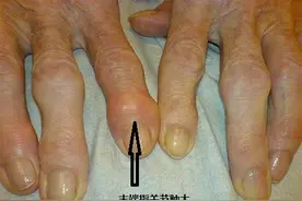 病例分享-骨关节炎（Osteoarthritis）图片