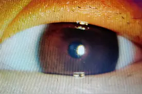 头皮发麻！26岁姑娘睫毛根长满蠕动的螨虫图片