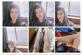 陈学冬双腿被水母蛰成筛子，医生提醒千万要注意，严重可致死图片