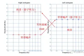 纯音测试——手把手教你做掩蔽（一）图片