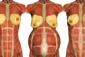 腹直肌分离是怎么一回事？图片