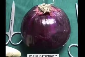剖腹产=打个麻药+切一刀+睡一觉？看看这颗洋葱，就知多遭罪了图片
