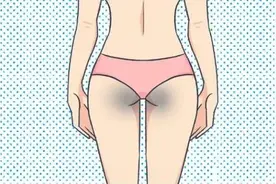 成年人的屁屁为何总有两团黑？图片