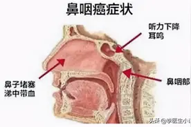 鼻咽癌放疗后还用化疗吗？一般不需要再做化疗了，对治疗意义不大图片