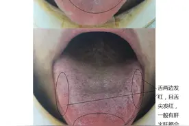 心肝火旺怎么调，送你一个方子，疏肝理气，滋阴清热，健脾祛湿图片