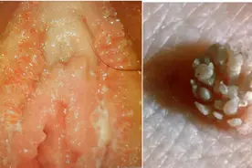 湿疣也有“真假之分”？图片