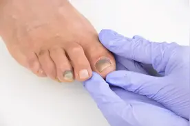 得了灰指甲，应该怎么办？图片