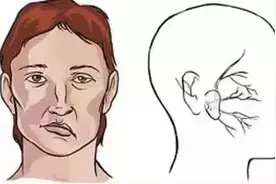 眼皮跳个不停，小心面肌痉挛找上你图片