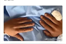 太心疼了！云南辅警抓偷渡蛇头被咬掉1.5公分手指图片