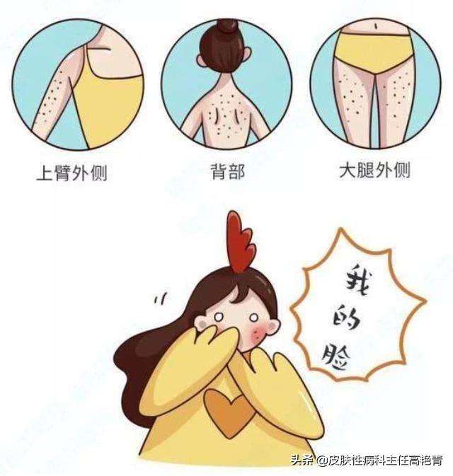 毛周角化粟丘疹