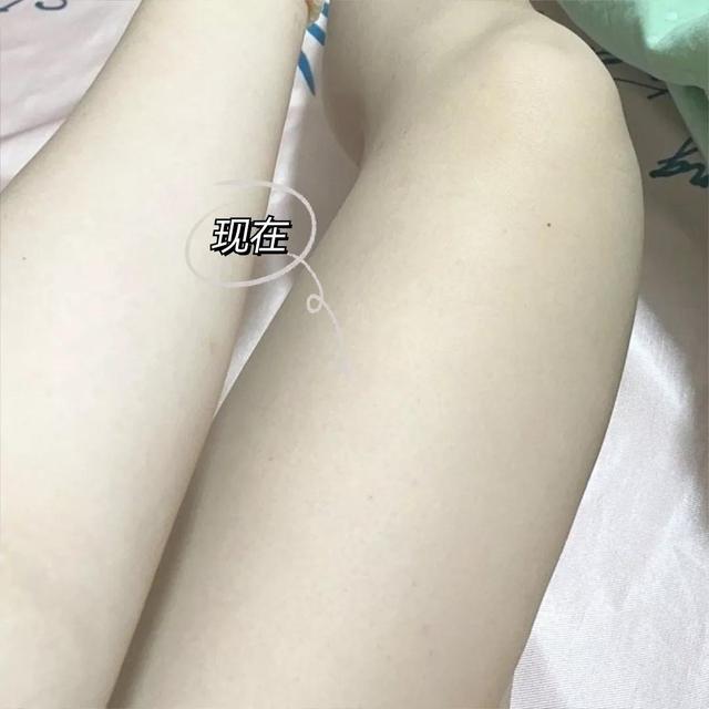 果酸换肤治疗鸡皮肤要一直做吗