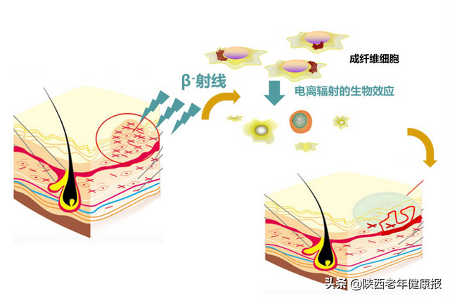 汗孔角化专用