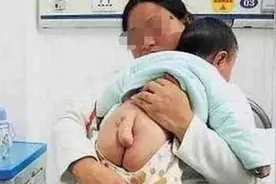 6个月男婴长出5公分“小尾巴”！听完医生的一席话，悔不该当初图片