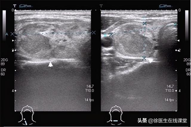 双侧甲状腺多发胶质结节 双侧甲状腺多发胶质结节2类