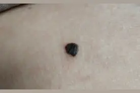 再次提醒：黑痣长在这3个部位，或与癌症息息相关，及时处理图片