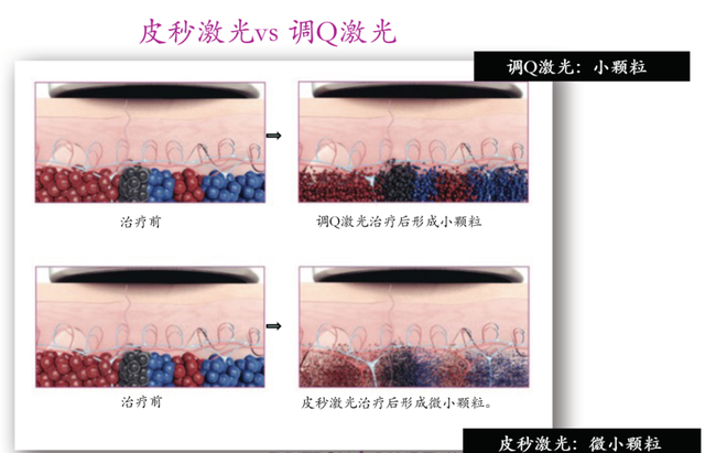 激光点脂溢角化会留下疤痕吗