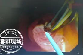 男子体内出现大量活肝吸虫，医生：和饮食习惯有关图片