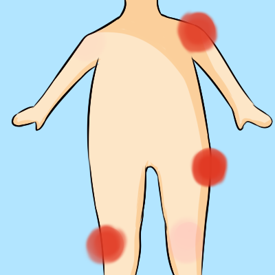 尿素霜涂在鸡皮肤上有点痛