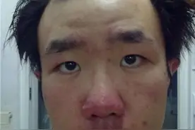 酒糟鼻，怎么办？图片