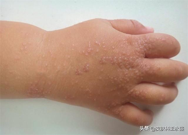 后背湿疹用什么药膏最有效,皮肤湿疹抹点啥好呢? - 冷求网