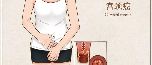 食管鳞癌非角化型