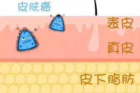 皮肤癌：你能认出“百变”的我吗？图片