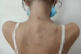 12岁女孩患“不死的癌症”，每天抠到流血！这种病极易与湿疹混淆图片