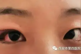 「医学揭秘」小小麦粒肿，我来对付TA图片
