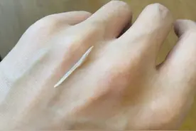 歌手张杰吃鱼不慎卡到食道，连夜去医院做了鱼骨摘除，粉丝很心疼图片