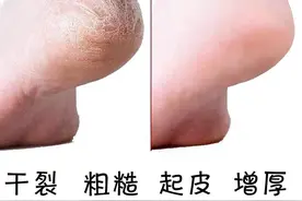 脚后跟脱皮干裂，一个方法搞定图片