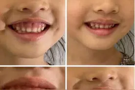 孩子笑起来总会露出牙龈，千万别忽视，这个时候矫正最好图片