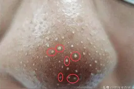 鼻子上挤出来的白色丝状物，到底是啥？皮肤医生教你几招祛除图片