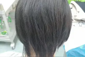 不剃发FUE植发图片