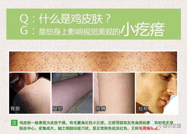腿上毛囊炎导致鸡皮肤厉害