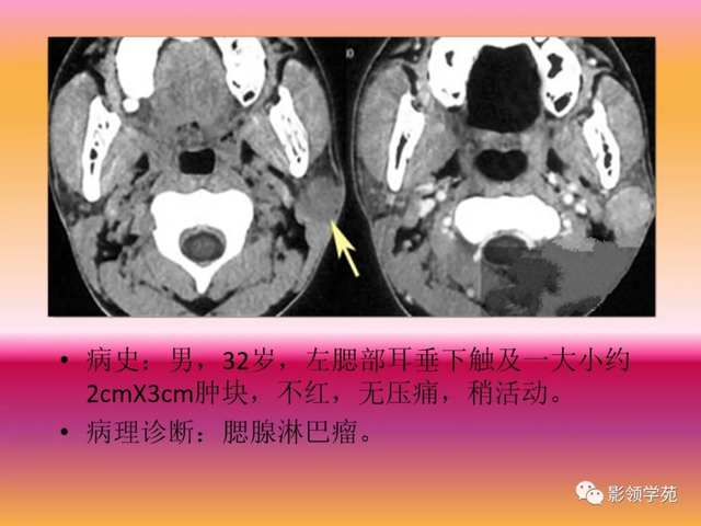 腮腺角化型鳞癌