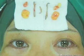做完眼袋就后悔？听医生分享几个祛眼袋的真相图片