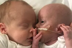 俩胎儿在妈妈子宫里抢食，弟弟出生时不到1斤重，奇迹般活了下来图片