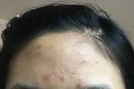 脸上总是长粉刺，又感觉痒痒的是怎么回事？图片