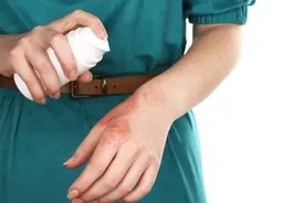 烧烫伤越疼，病情反而越轻图片