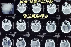鲍曼不动颅内感染合并隐球菌脑膜炎患者突发脑疝图片
