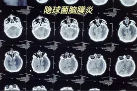 鲍曼不动颅内感染合并隐球菌脑膜炎患者突发脑疝图片