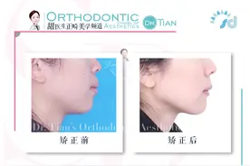 正畸时，需要牵引智齿前移代替磨牙，那什么样的智齿适合牵引呢？图片