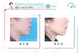 正畸时，需要牵引智齿前移代替磨牙，那什么样的智齿适合牵引呢？图片