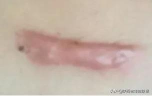 汗孔角化专用 汗孔角化专用